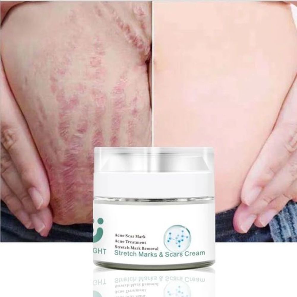 - SCAR Removal Cream For Old Scars-Stretch Mark Removal
Cream for Men And …